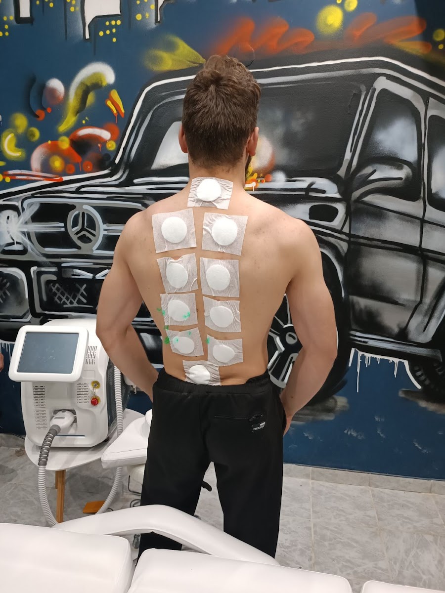 Bidaya - Lasersko uklanjanje tetovaža i hidžama - foto 3